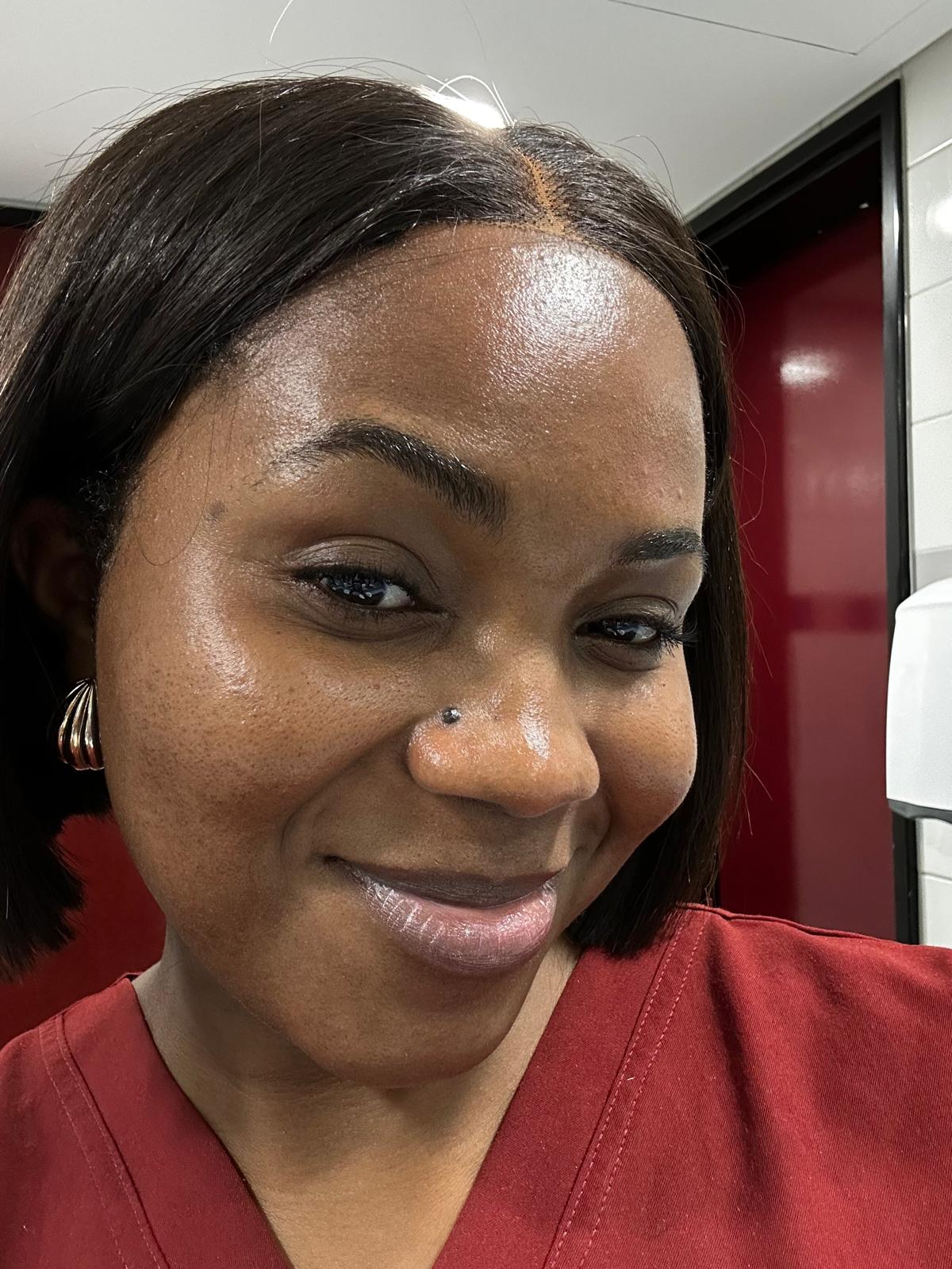 After Acne Scarring Treatment