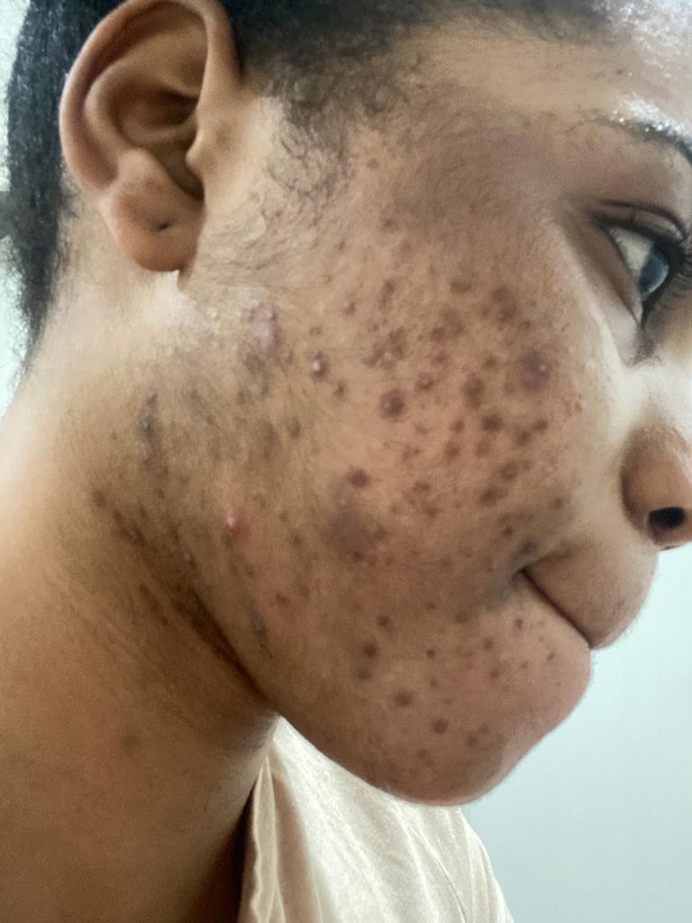Before Acne Scarring Treatment