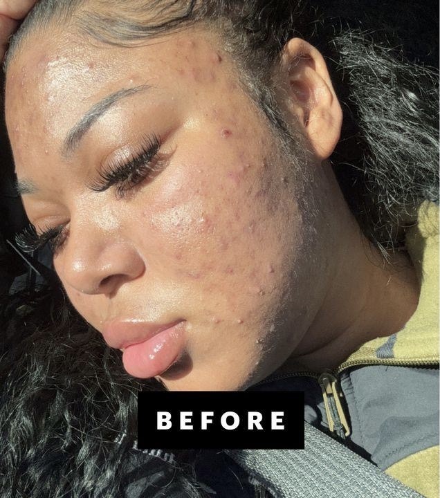 Before Acne Treatment