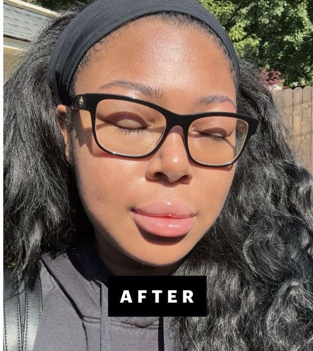 After Acne Treatment