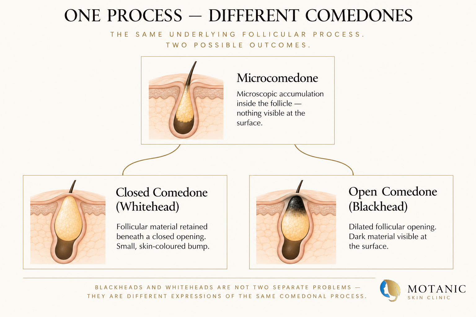 Diagram showing how a microcomedone can present as either a closed comedone (whitehead) or an open comedone (blackhead), depending on the state of the follicular opening — not as a sequential progression.