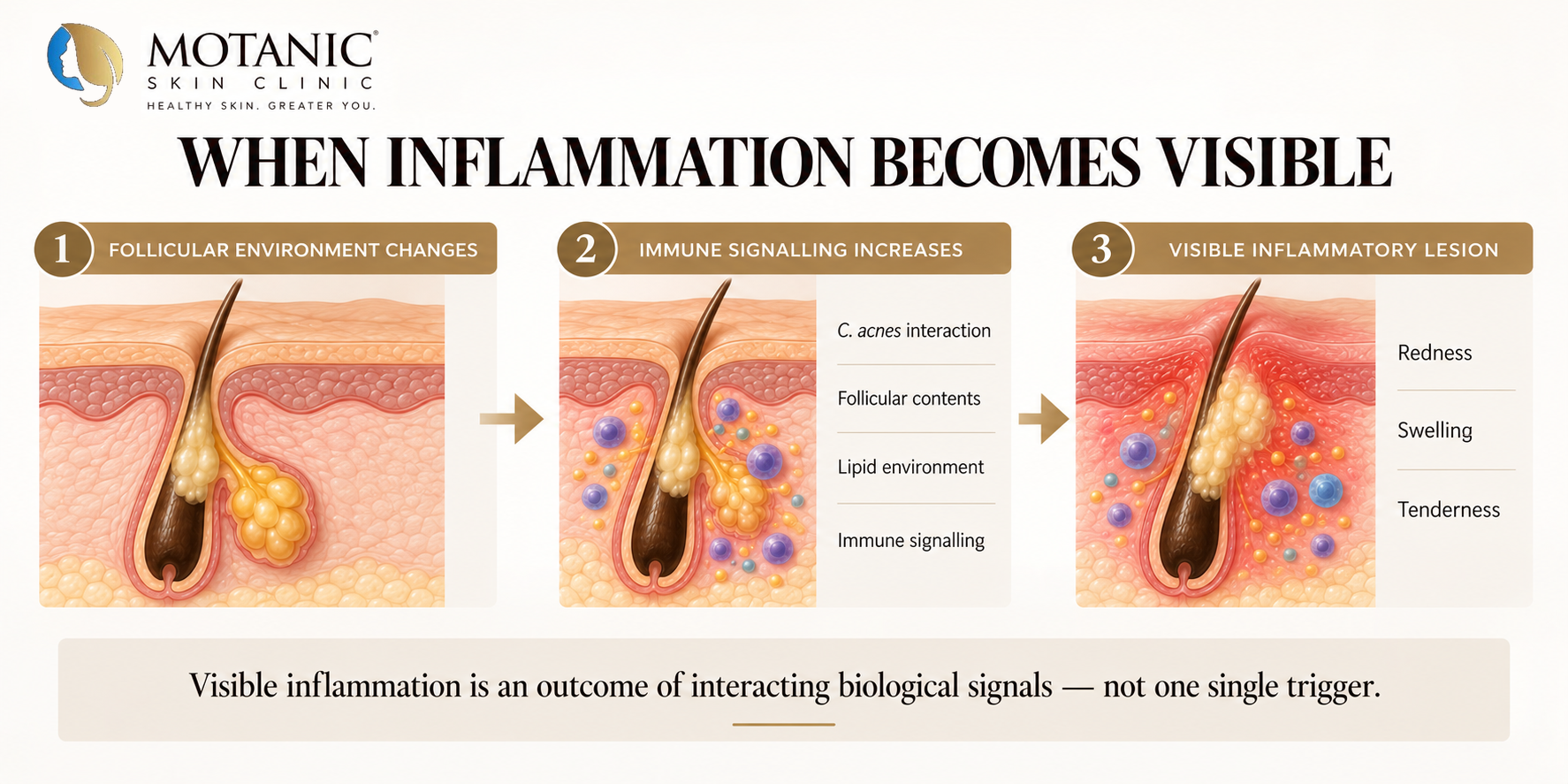 Acne inflammation diagram showing the progression from changes in the follicular environment to increased immune signalling and a visible inflammatory lesion.