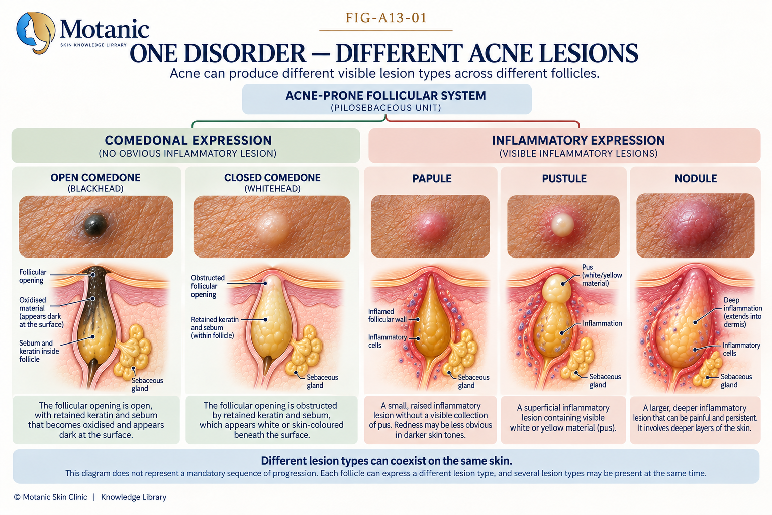 Diagram comparing open and closed comedones, papules, pustules and nodules as different acne lesion types.
