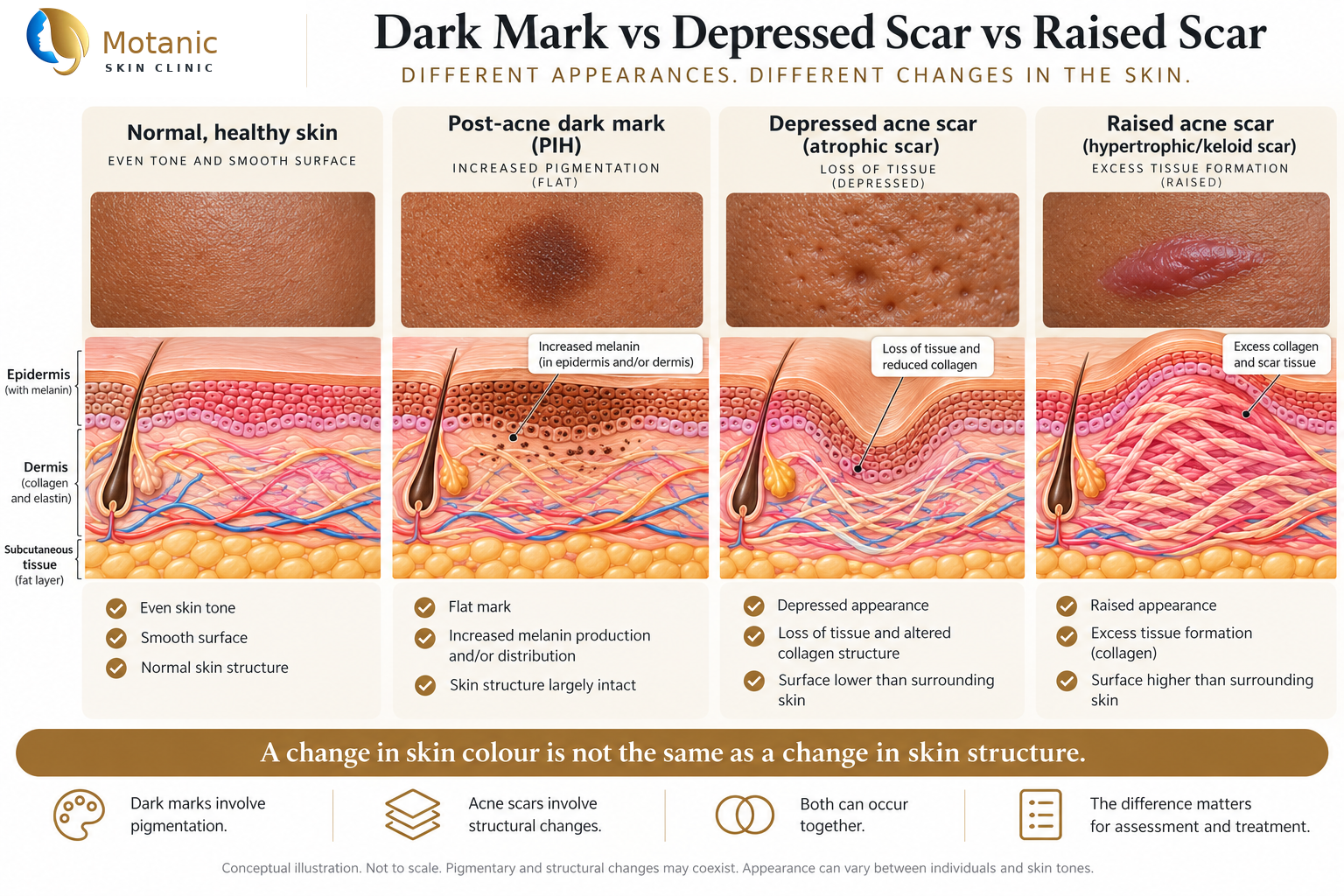 Acne scars vs dark marks: medical illustration comparing post-inflammatory hyperpigmentation, depressed acne scars and raised acne scars.