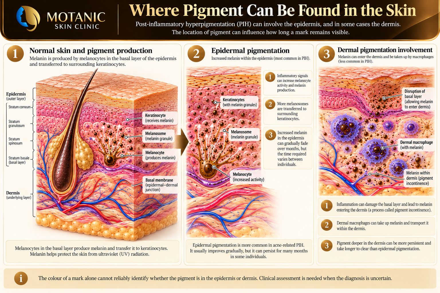 Why Does Acne Leave Dark Marks? Educational skin cross-sections explaining melanocytes and melanosomes, epidermal pigmentation and melanin retained by macrophages in the dermis.